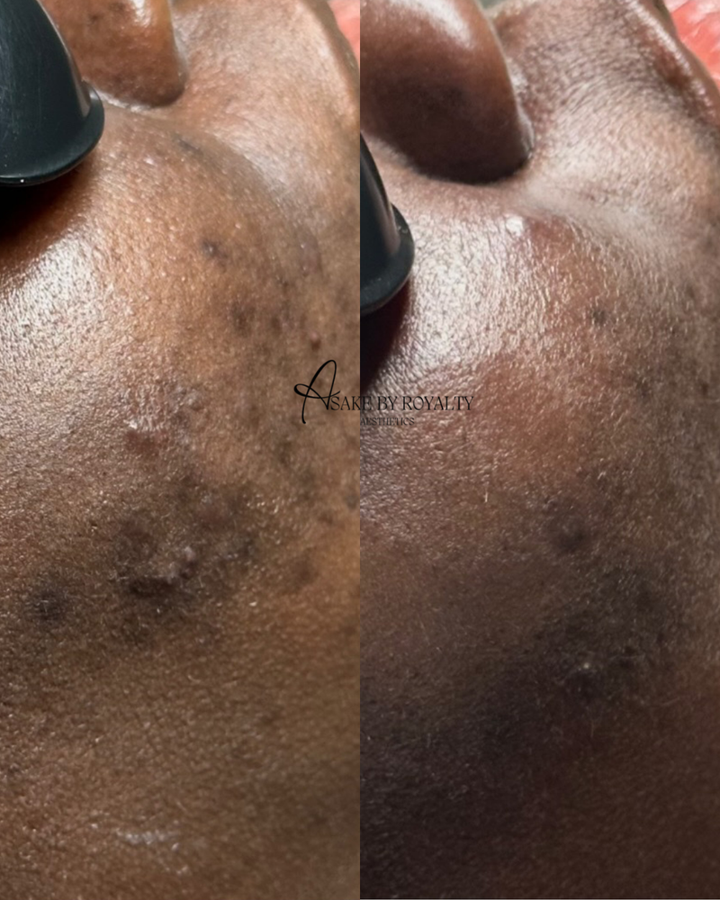 Skin Ripping Transformation Skin Transformation – Asake by Royalty Aesthetics