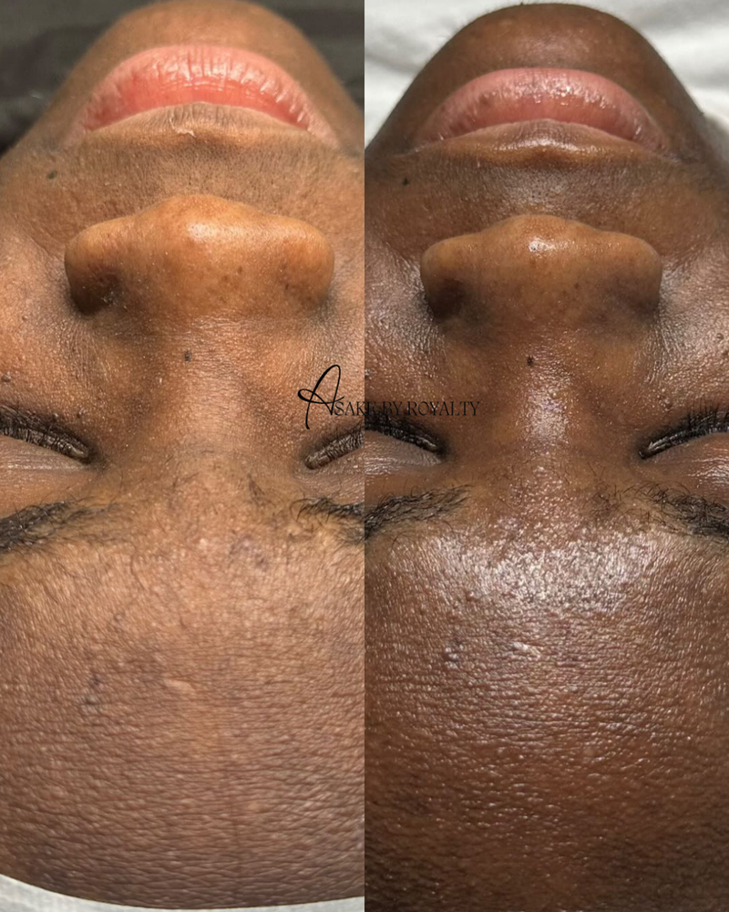 Skin Ripping Transformation Skin Transformation – Asake by Royalty Aesthetics