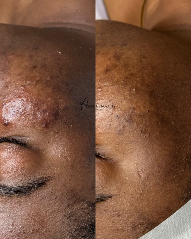 Skin Ripping Transformation Skin Transformation – Asake by Royalty Aesthetics